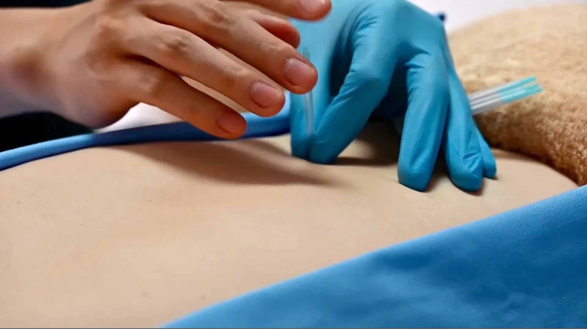 クイック鍼（マッサージに追加可能）