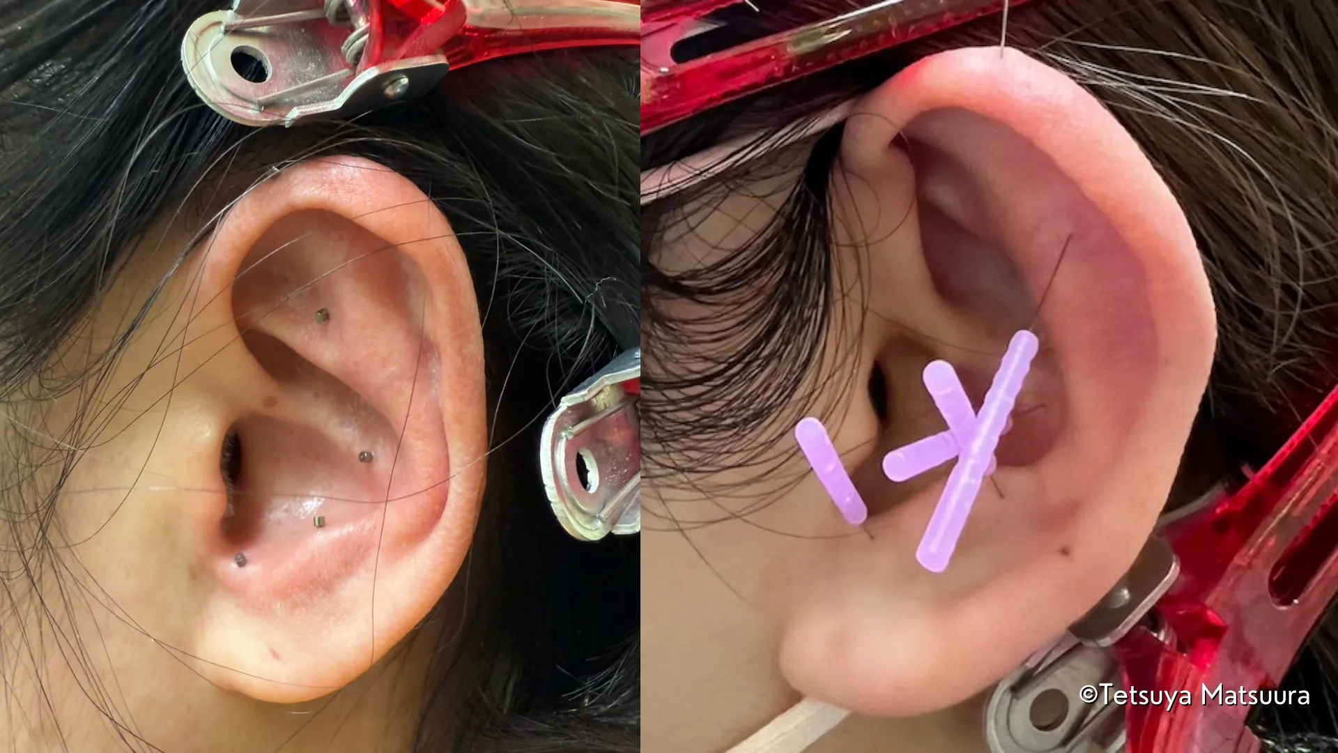 本格鍼灸メニュー